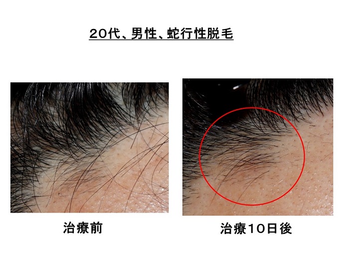 円形脱毛症　病院